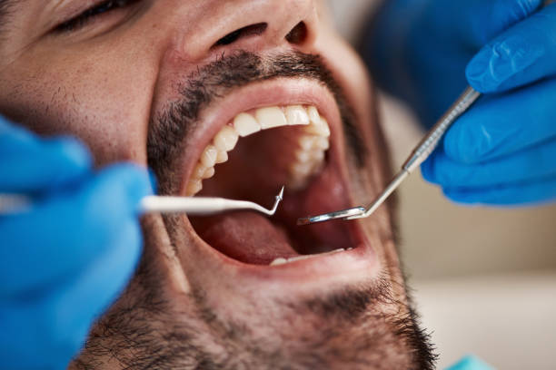 Best Emergency Dental Care for Broken or Chipped Teeth in Calumet, PA