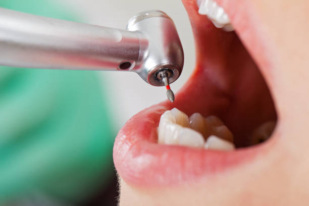 Best Emergency Wisdom Teeth Removal in Calumet, PA